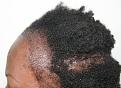 Click image for larger version

Name:	np - immediate post-op R profile.jpg
Views:	257
Size:	96.0 KB
ID:	470329