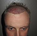 Click image for larger version

Name:	Post_op_2.jpg
Views:	573
Size:	86.3 KB
ID:	470387