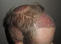 Click image for larger version

Name:	Post_op_3.jpg
Views:	550
Size:	92.3 KB
ID:	470388