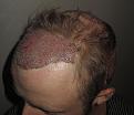Click image for larger version

Name:	Post_op_4.jpg
Views:	515
Size:	90.5 KB
ID:	470389