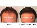 Click image for larger version

Name:	Hair Transplant Slides.470.jpg
Views:	438
Size:	63.5 KB
ID:	470449