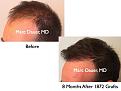 Click image for larger version

Name:	Hair Transplant Slides.471.jpg
Views:	385
Size:	60.4 KB
ID:	470450
