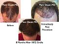Click image for larger version

Name:	Hair Transplant Slides.473.jpg
Views:	411
Size:	83.0 KB
ID:	470452