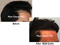 Click image for larger version

Name:	Hair Transplant Slides.477.jpg
Views:	360
Size:	58.8 KB
ID:	470458