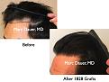 Click image for larger version

Name:	Hair Transplant Slides.476.jpg
Views:	345
Size:	64.4 KB
ID:	470459