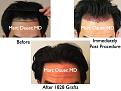 Click image for larger version

Name:	Hair Transplant Slides.475.jpg
Views:	387
Size:	71.7 KB
ID:	470460