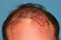 Click image for larger version

Name:	dc immediate post-op front.jpg
Views:	288
Size:	60.0 KB
ID:	470595