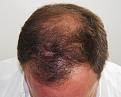 Click image for larger version

Name:	dc 4 year post-op chin down.jpg
Views:	326
Size:	93.9 KB
ID:	470596