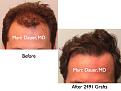 Click image for larger version

Name:	Hair Transplant Slides.503.jpg
Views:	412
Size:	64.6 KB
ID:	470640
