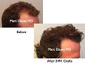 Click image for larger version

Name:	Hair Transplant Slides.505.jpg
Views:	357
Size:	62.5 KB
ID:	470642