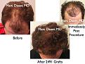 Click image for larger version

Name:	Hair Transplant Slides.506.jpg
Views:	404
Size:	80.9 KB
ID:	470643