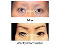 Click image for larger version

Name:	Hair Transplant Slides.504.jpg
Views:	869
Size:	56.8 KB
ID:	470752