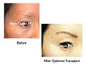 Click image for larger version

Name:	Hair Transplant Slides.506.jpg
Views:	513
Size:	50.8 KB
ID:	470754