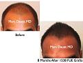Click image for larger version

Name:	Hair Transplant Slides.515.jpg
Views:	350
Size:	33.1 KB
ID:	470836