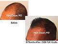 Click image for larger version

Name:	Hair Transplant Slides.516.jpg
Views:	327
Size:	32.5 KB
ID:	470837