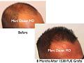 Click image for larger version

Name:	Hair Transplant Slides.517.jpg
Views:	355
Size:	35.1 KB
ID:	470838