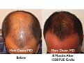 Click image for larger version

Name:	Hair Transplant Slides.518.jpg
Views:	392
Size:	43.0 KB
ID:	470839