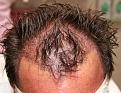 Click image for larger version

Name:	sm2 immediate post-op chin down.jpg
Views:	476
Size:	93.6 KB
ID:	470845
