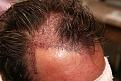 Click image for larger version

Name:	sm2 immediate post-op L profile.jpg
Views:	450
Size:	96.3 KB
ID:	470846