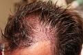 Click image for larger version

Name:	sm2 immediate post-op R profile.jpg
Views:	439
Size:	96.8 KB
ID:	470847