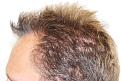 Click image for larger version

Name:	sm2 4 years post-op R profile.jpg
Views:	458
Size:	95.7 KB
ID:	470852