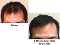 Click image for larger version

Name:	Hair Transplant Slides.521.jpg
Views:	476
Size:	35.7 KB
ID:	470940