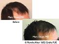 Click image for larger version

Name:	Hair Transplant Slides.522.jpg
Views:	438
Size:	34.6 KB
ID:	470941