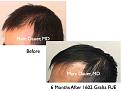 Click image for larger version

Name:	Hair Transplant Slides.523.jpg
Views:	464
Size:	36.8 KB
ID:	470942