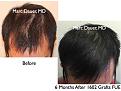 Click image for larger version

Name:	Hair Transplant Slides.524.jpg
Views:	453
Size:	41.3 KB
ID:	470943