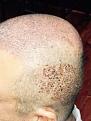 Click image for larger version

Name:	2nd day after surgery-3.jpg
Views:	1158
Size:	10.3 KB
ID:	471009