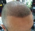 Click image for larger version

Name:	5th day after surgery-2.jpg
Views:	1210
Size:	25.7 KB
ID:	471012