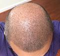 Click image for larger version

Name:	9th day after surgery-1.jpg
Views:	1304
Size:	92.5 KB
ID:	471014