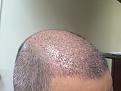 Click image for larger version

Name:	9th day after surgery-2.jpg
Views:	1250
Size:	94.3 KB
ID:	471015