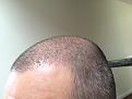 Click image for larger version

Name:	9th day after surgery-3.jpg
Views:	1283
Size:	93.2 KB
ID:	471016