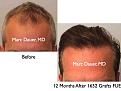 Click image for larger version

Name:	Hair Transplant Slides.539.jpg
Views:	471
Size:	37.1 KB
ID:	471040