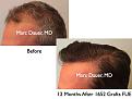 Click image for larger version

Name:	Hair Transplant Slides.541.jpg
Views:	408
Size:	37.0 KB
ID:	471042
