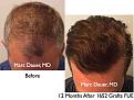 Click image for larger version

Name:	Hair Transplant Slides.542.jpg
Views:	430
Size:	45.5 KB
ID:	471043