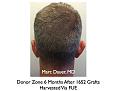 Click image for larger version

Name:	Hair Transplant Slides.543.jpg
Views:	274
Size:	35.9 KB
ID:	471044