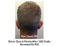 Click image for larger version

Name:	Hair Transplant Slides.543.jpg
Views:	362
Size:	35.9 KB
ID:	471044