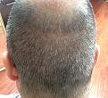 Click image for larger version

Name:	13th day after surgery-2.jpg
Views:	1042
Size:	91.4 KB
ID:	471046