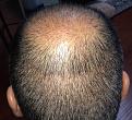 Click image for larger version

Name:	13th day after surgery-4.jpg
Views:	1137
Size:	97.1 KB
ID:	471048