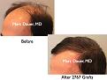 Click image for larger version

Name:	Hair Transplant Slides.555.jpg
Views:	418
Size:	60.6 KB
ID:	471108