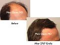 Click image for larger version

Name:	Hair Transplant Slides.556.jpg
Views:	421
Size:	62.0 KB
ID:	471109