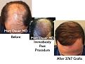 Click image for larger version

Name:	Hair Transplant Slides.557.jpg
Views:	370
Size:	76.4 KB
ID:	471110