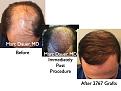 Click image for larger version

Name:	Hair Transplant Slides.557.jpg
Views:	457
Size:	76.4 KB
ID:	471110