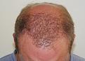 Click image for larger version

Name:	ts 1 year post-op chin down.jpg
Views:	321
Size:	92.4 KB
ID:	471163