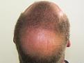 Click image for larger version

Name:	ts 1 year post-op chin up (2).jpg
Views:	324
Size:	94.9 KB
ID:	471164