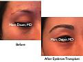 Click image for larger version

Name:	Hair Transplant Slides.565.jpg
Views:	505
Size:	68.5 KB
ID:	471334