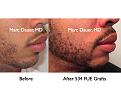 Click image for larger version

Name:	Hair Transplant Slides.571.jpg
Views:	446
Size:	74.4 KB
ID:	471349