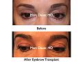 Click image for larger version

Name:	Hair Transplant Slides.592.jpg
Views:	907
Size:	68.6 KB
ID:	471439